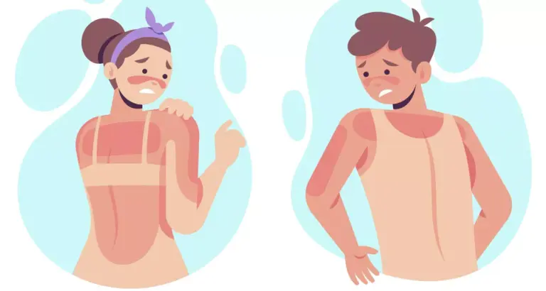 Kako prepoznati različite stupnjeve opeklina