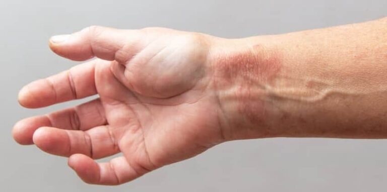 Znakovi da opeklina zahtijeva stručnu njegu